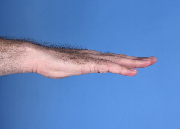 Photo of a man's hand after surgery