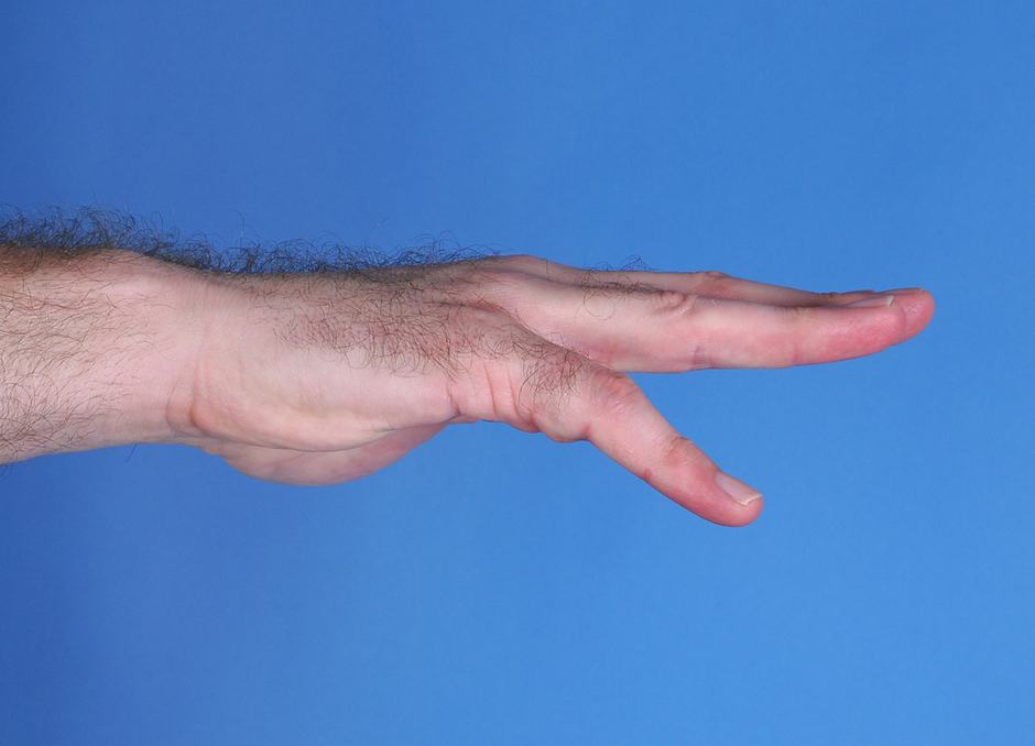 Photo of a man's hand before surgery