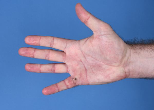 Photo of a man's hand after surgery