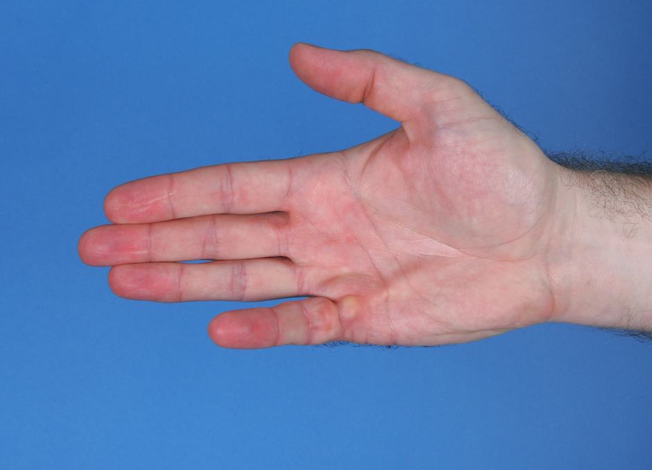Photo of a man's hand before surgery