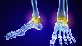 How we use a 3D printer to replace ankle bones and restore movement