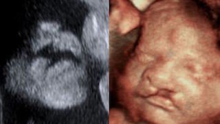 Why to avoid ‘keepsake’ 3-D and 4-D ultrasounds
