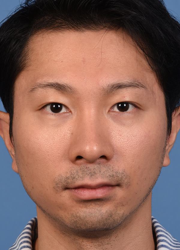 Post photo of man getting botox