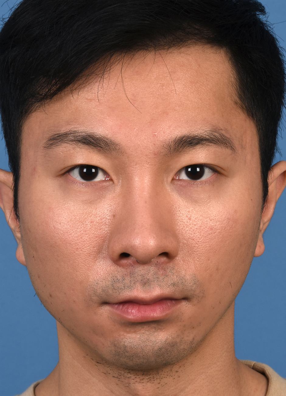Pre photo of man getting botox