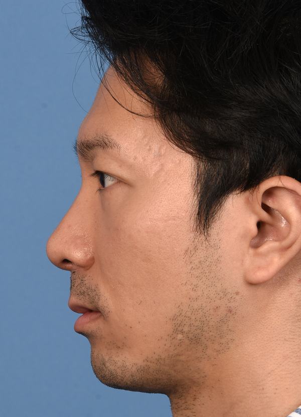 Post photo of man getting botox