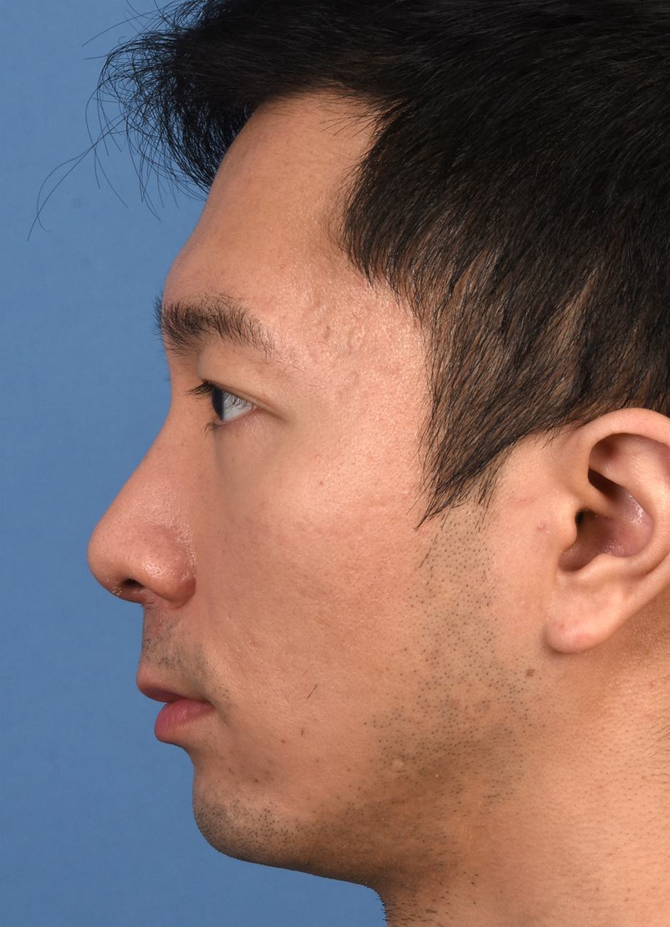 Pre photo of man getting botox