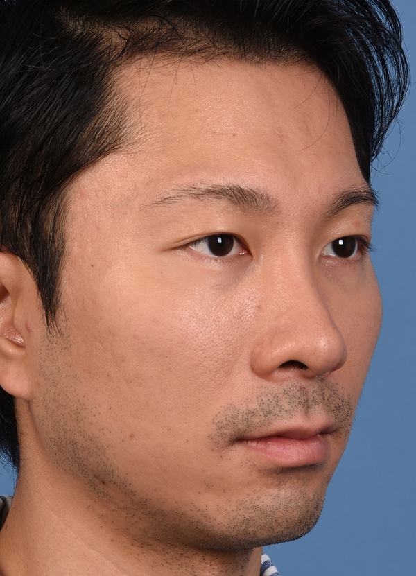 Post photo of man getting botox