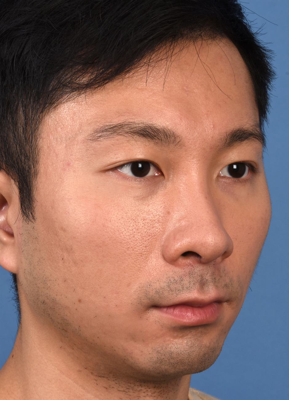 Pre photo of man getting botox