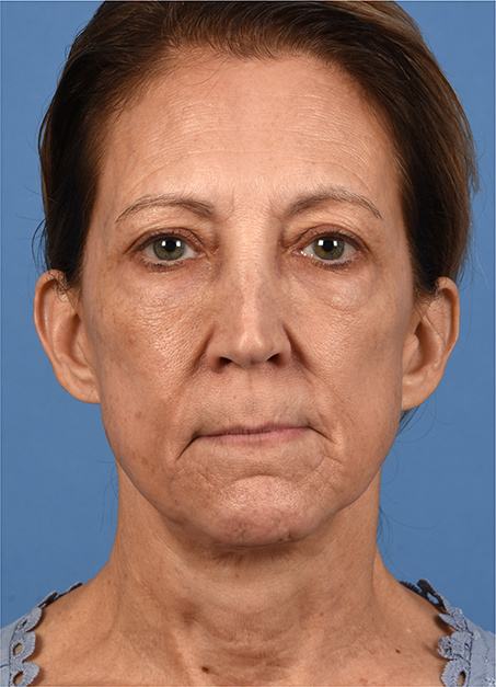 Post photo of a woman getting a facelift