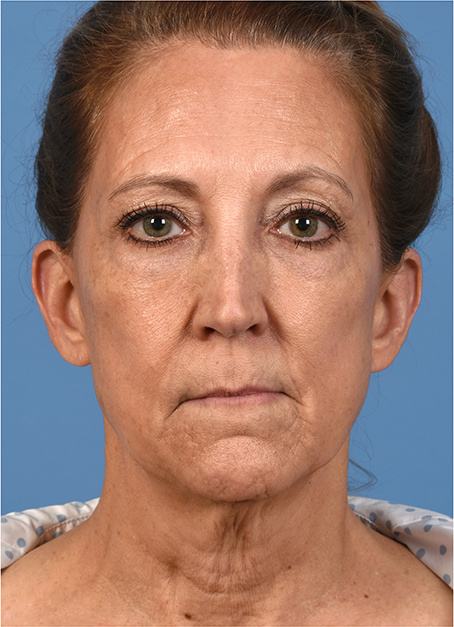 Pre photo of a woman getting a facelift