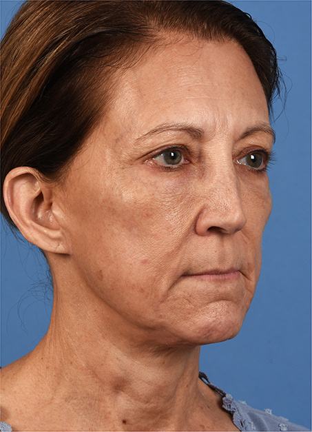 Post photo of a woman getting a facelift
