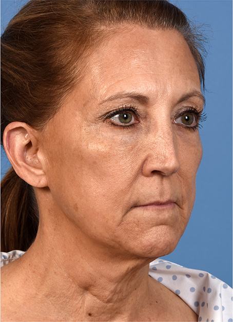Pre photo of a woman getting a facelift