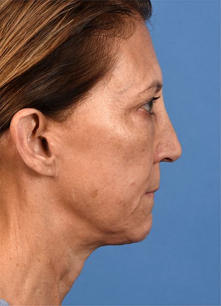 Post photo of a woman getting a facelift