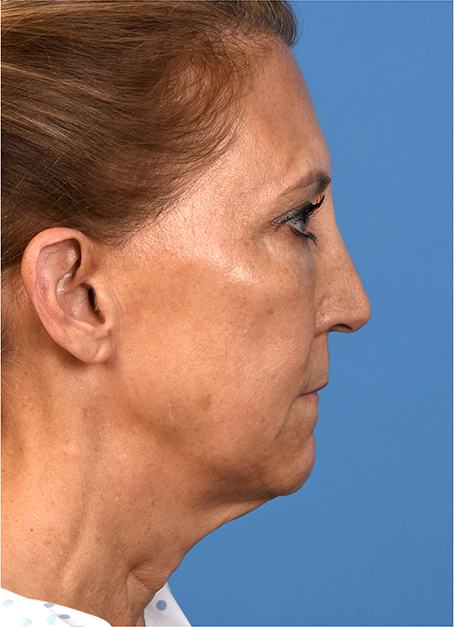 Pre photo of a woman getting a facelift
