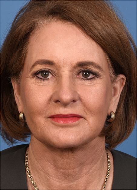 Post photo of woman getting face and eye treatments