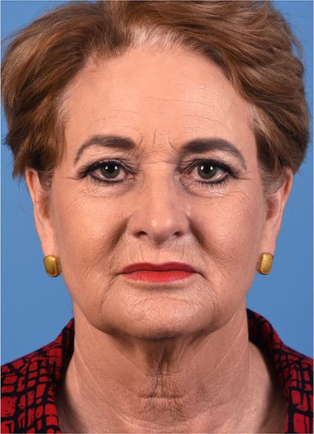Pre photo of woman getting face and eye treatments