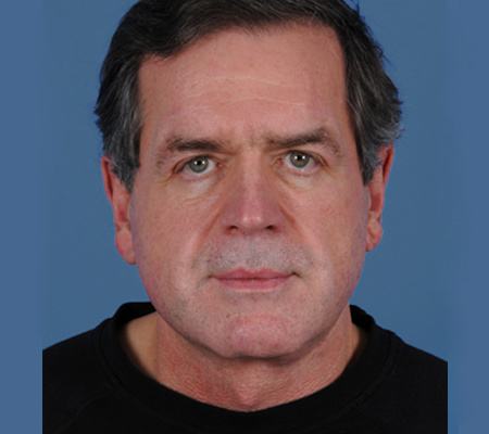 Post photo of a man getting a facelift