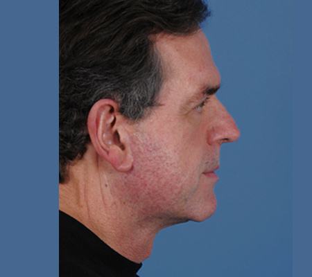 Post photo of a man getting a facelift