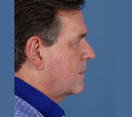 Pre photo of a man getting a facelift