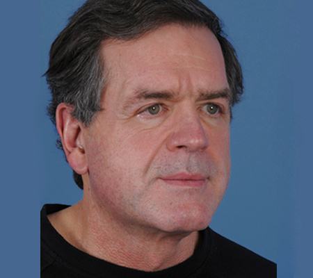 Post photo of a man getting a facelift