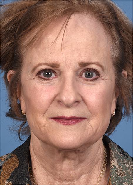 Post photo of a woman getting a facelift