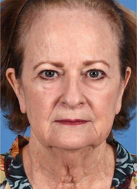 Pre photo of a woman getting a facelift