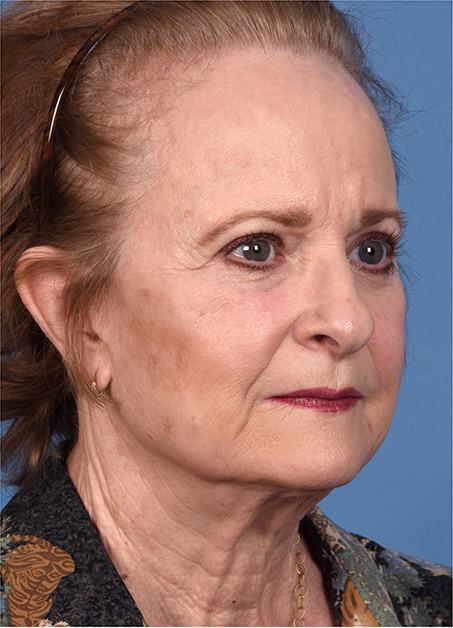 Post photo of a woman getting a facelift