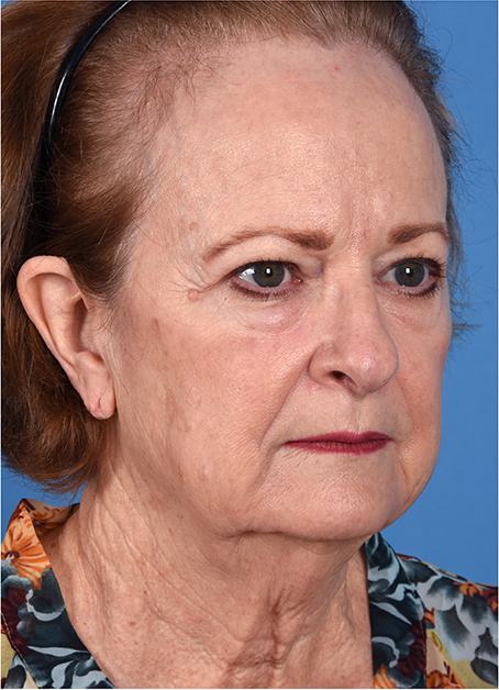 Pre photo of a woman getting a facelift