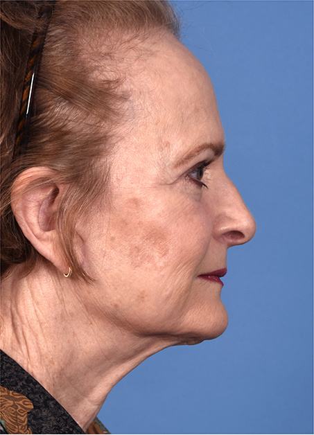 Post photo of a woman getting a facelift