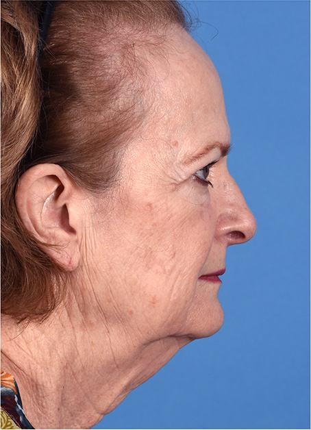 Pre photo of a woman getting a facelift