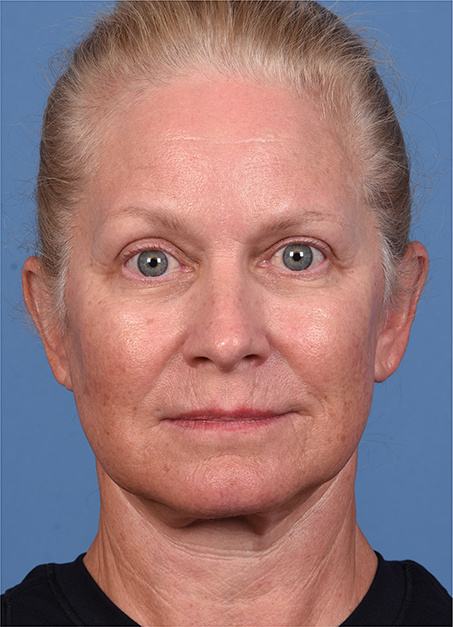 Post photo of woman getting an eye lift procedure