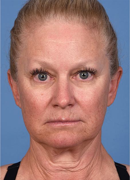 Pre photo of woman getting an eye lift procedure