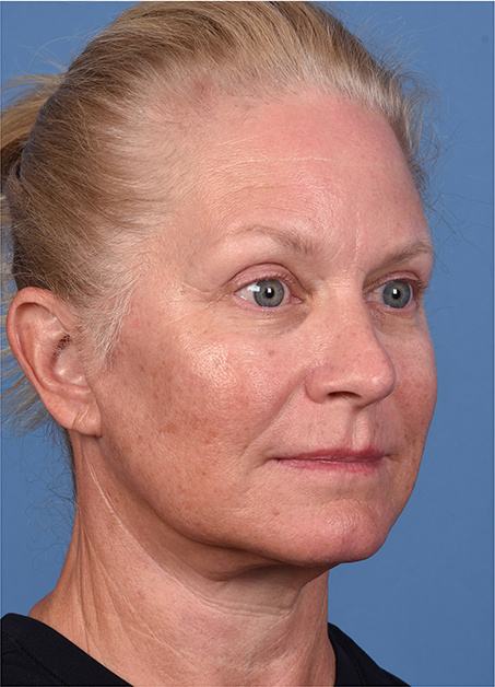 Post photo of woman getting an eye lift procedure