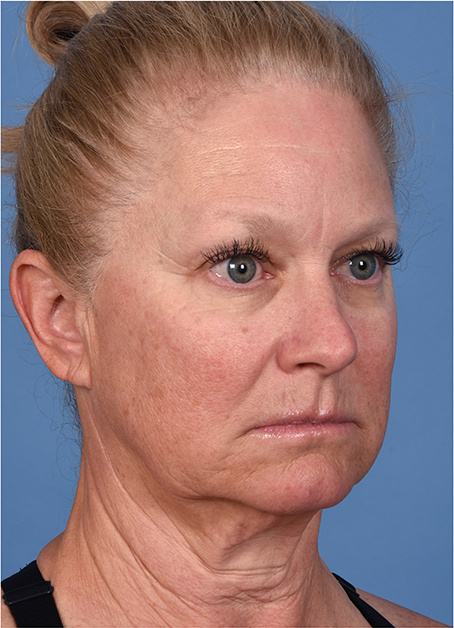 Pre photo of woman getting an eye lift procedure