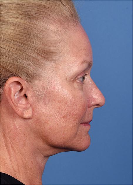 Post photo of woman getting an eye lift procedure