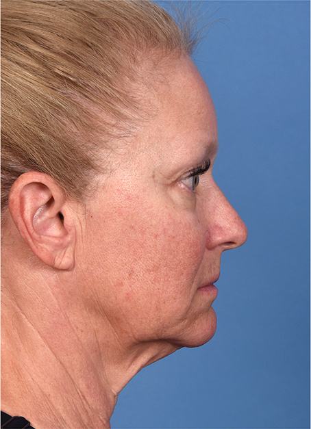 Pre photo of woman getting an eye lift procedure