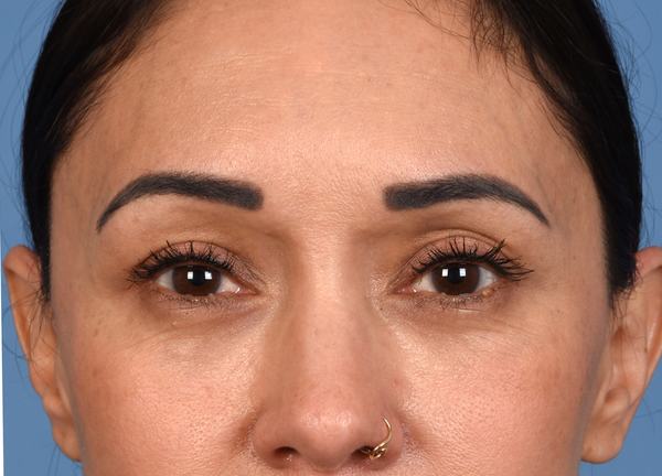 Post photo of woman getting an eye lift procedure
