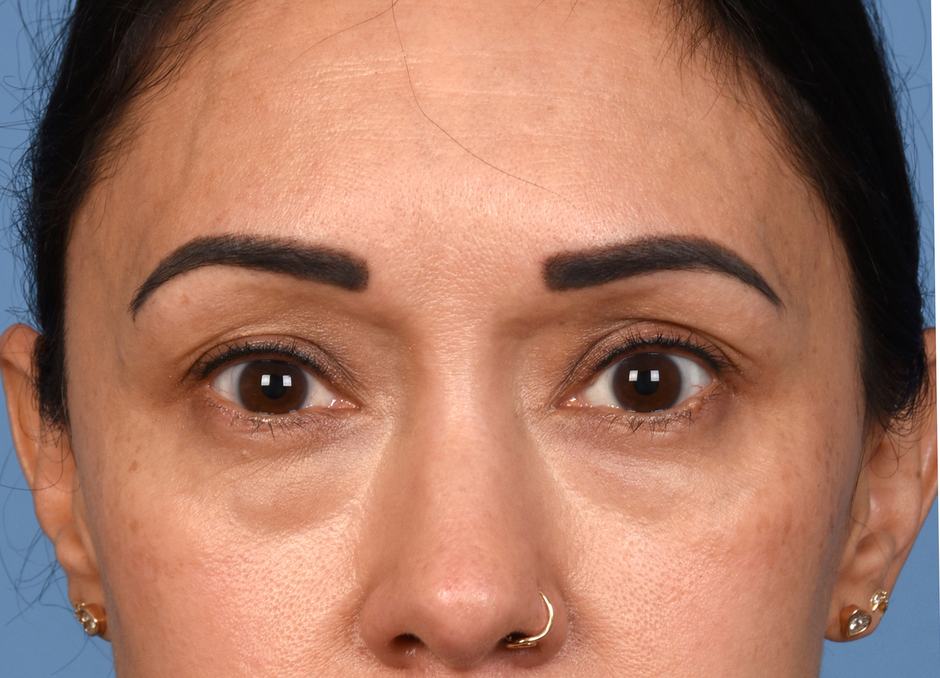 Pre photo of woman getting an eye lift procedure