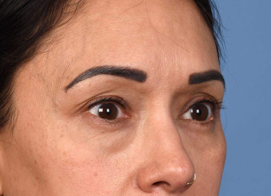 Pre photo of woman getting an eye lift procedure