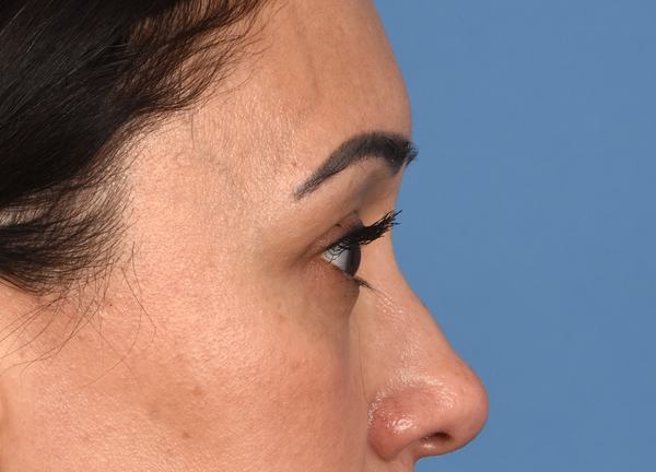 Post photo of woman getting an eye lift procedure