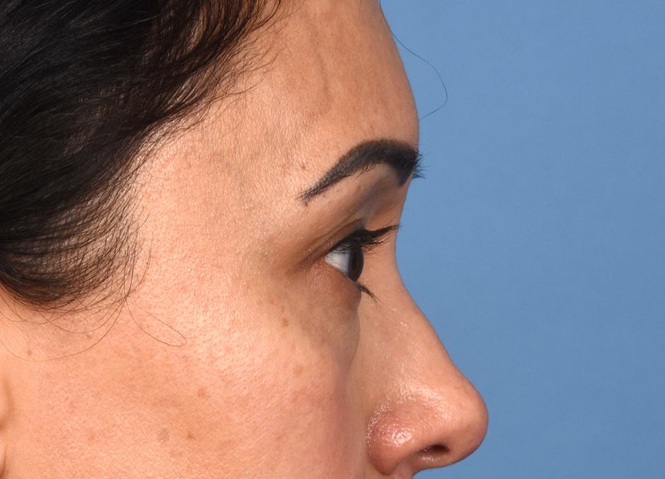 Pre photo of woman getting an eye lift procedure