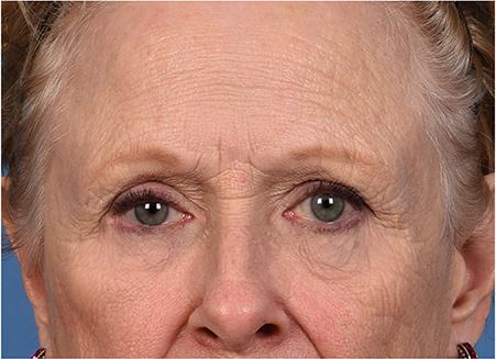 Post photo of woman getting an eye lift procedure