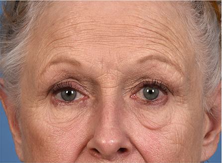 Pre photo of woman getting an eye lift procedure