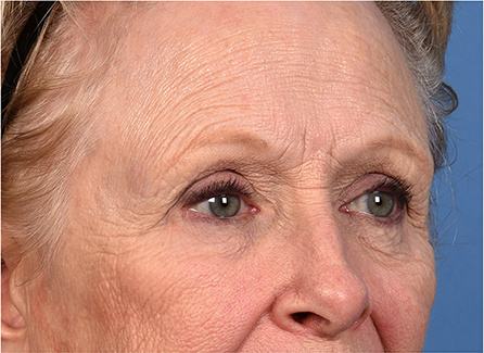 Post photo of woman getting an eye lift procedure