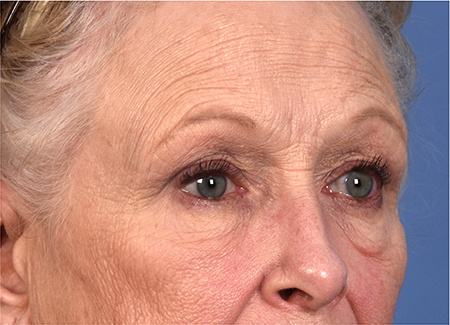 Pre photo of woman getting an eye lift procedure