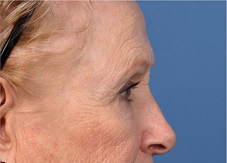 Post photo of woman getting an eye lift procedure