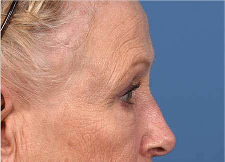 Pre photo of woman getting an eye lift procedure