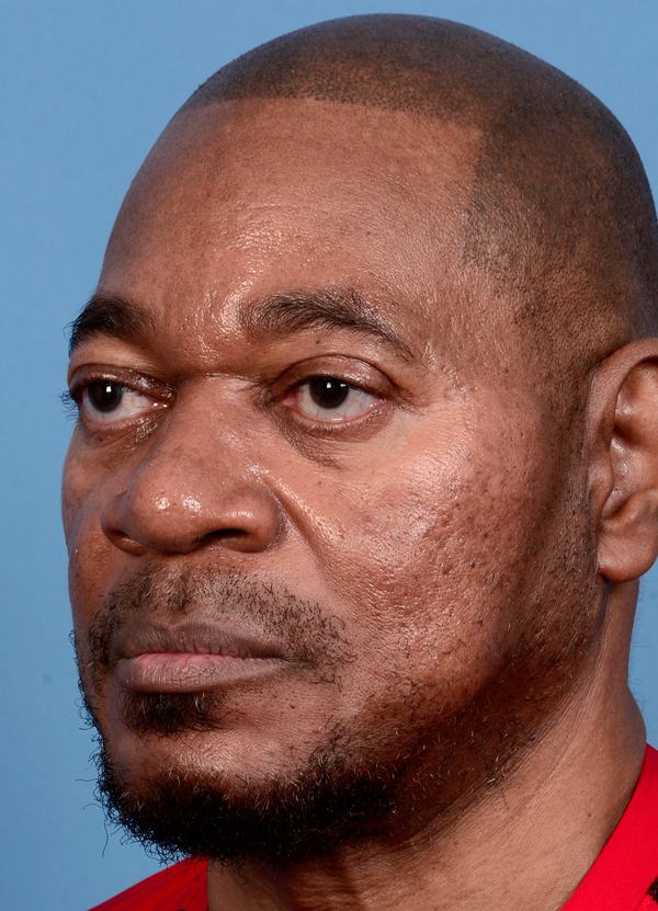 post photo of a man getting skin treatments