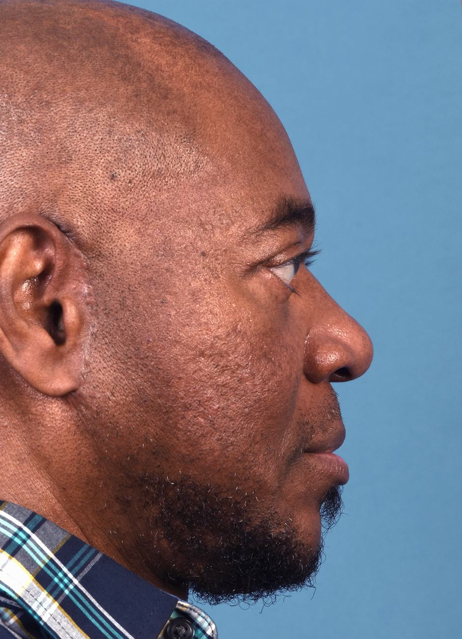 pre photo of a man getting skin treatments