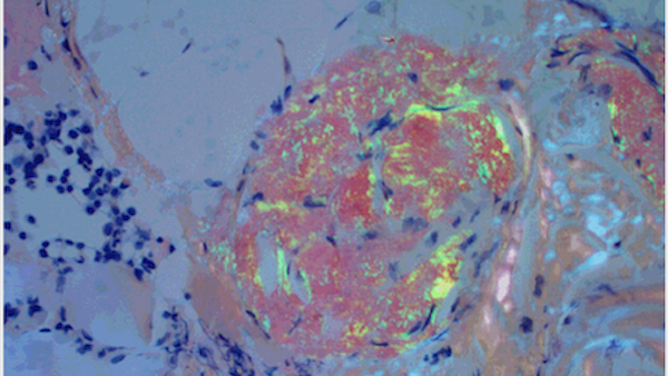 AL amyloidosis treatments offer patients hope and potentially a cure